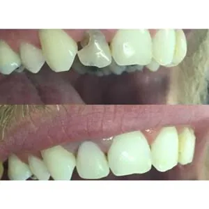 Udemy – Dental Composites – A cosmetic tooth filling 2023-8